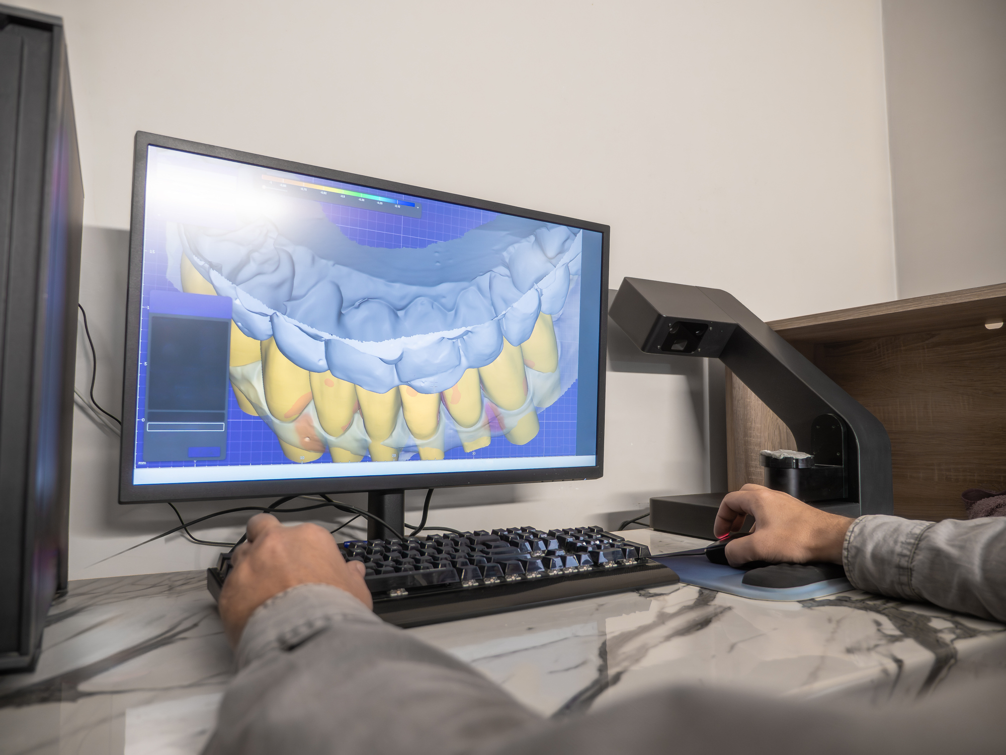 Full denture digital design and try-in Sydney dental lab